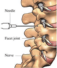 Non-Operative Treatment - Rojeh Melikian, M.D.