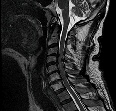 broken neck mri