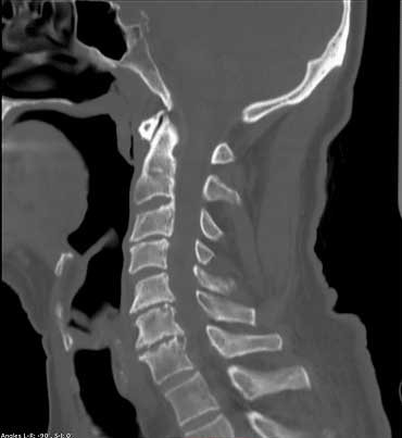 Cervical spine CT scan