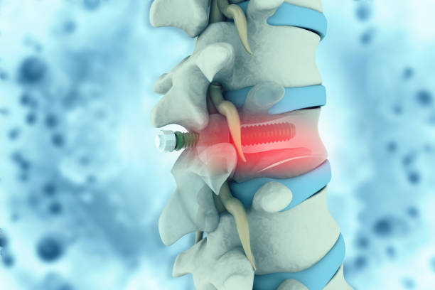 The Risks and Benefits of Spinal Stenosis Surgery